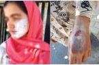 شکنجه دختر ۱۳ ساله با اتوی داغ توسط نامادری + عکس