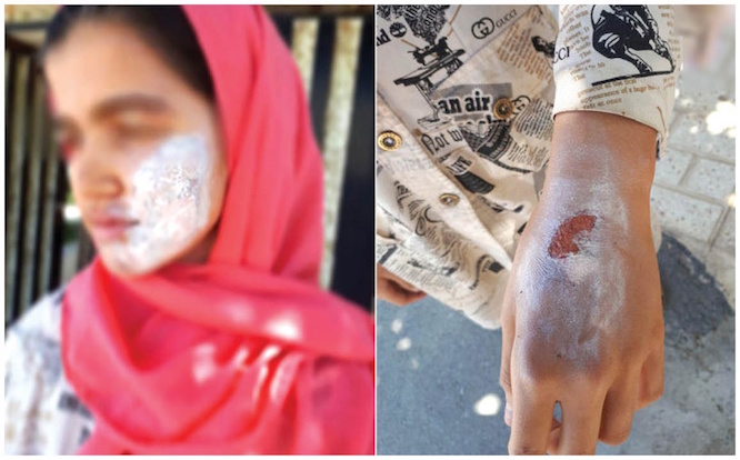 شکنجه دختر ۱۳ ساله با اتوی داغ توسط نامادری + عکس