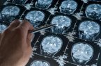 سلول های مغزی مبتلا به آلزایمر در مسیر درمان