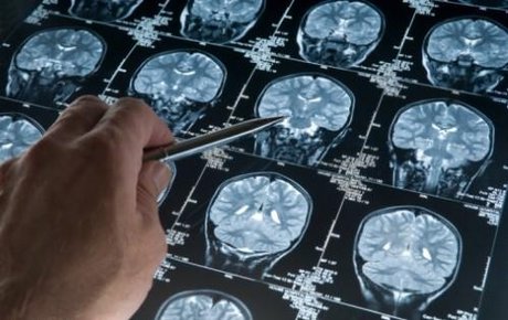 سلول های مغزی مبتلا به آلزایمر در مسیر درمان